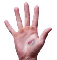 Blistered Palm